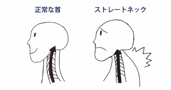 ストレートネック